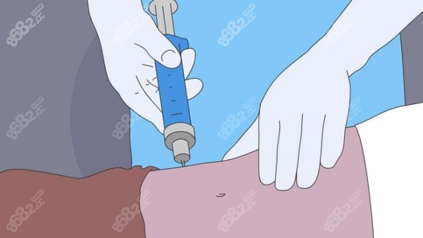 楊柳吸脂的預約渠道 楊柳吸脂的預約渠道