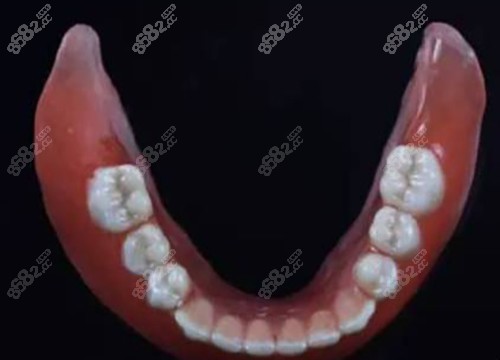 吸附性全口義齒