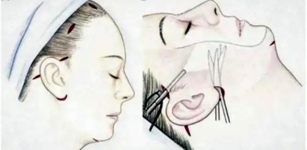 孫瑋?的速拉美原理細節(jié)