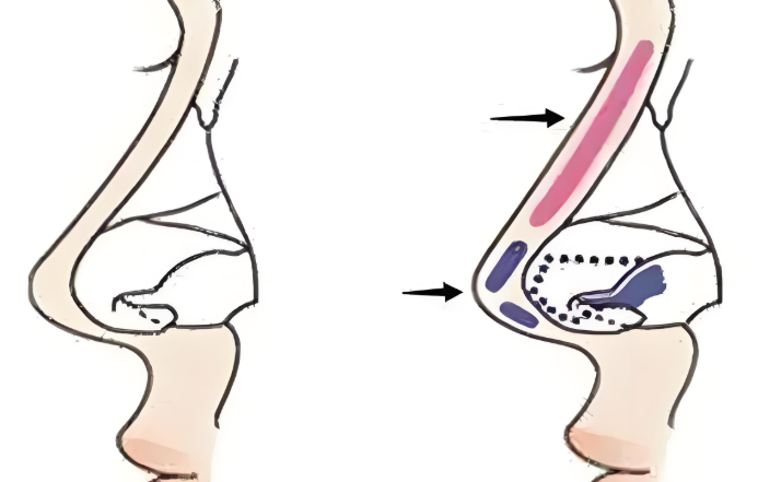 广州王旭彬和李闯鼻修复哪个技术更好？患者反馈对比