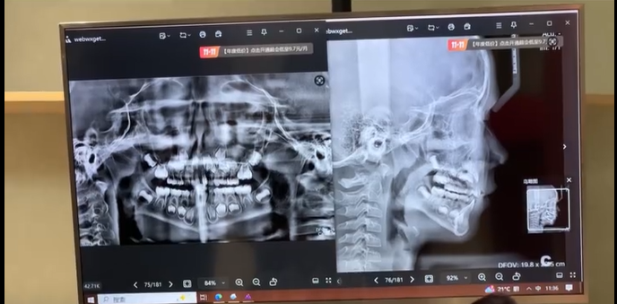 牙齿矫正周博士