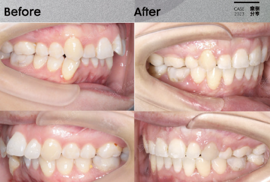 牙齿矫正周博士