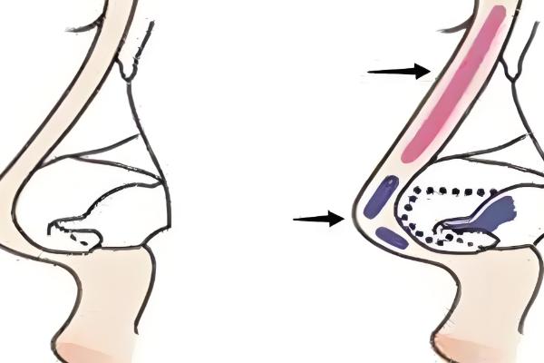 赵延勇小切口拉皮价格透明化！北京八大处3万起，技术优势竟这么多