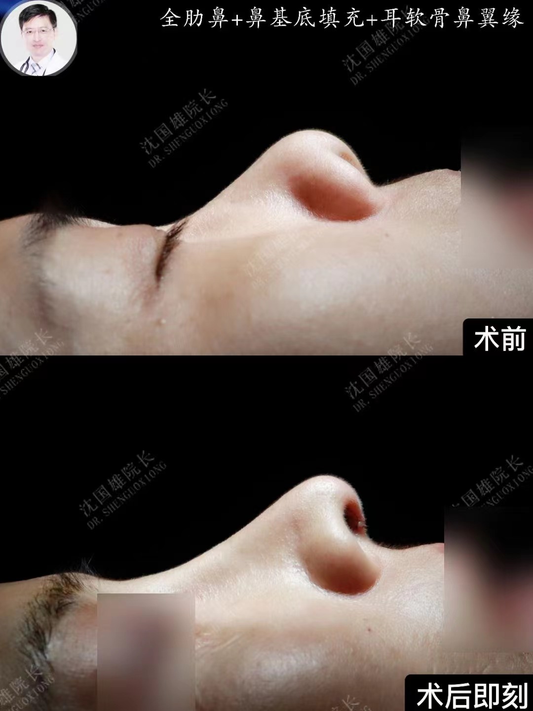 上海沈國雄醫(yī)生修復鼻子怎樣？實拍案例揭秘其鼻修復技術(shù)是否過硬