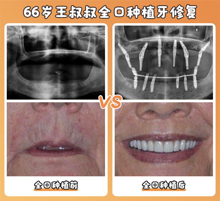 畢節(jié)盛華口腔真實(shí)成效——患者口碑的見證