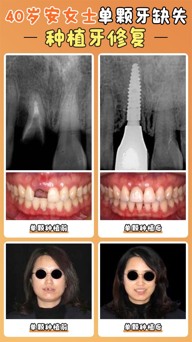 德國儒伽種植牙和瑞典諾貝爾種植牙在牙博士口腔的情況