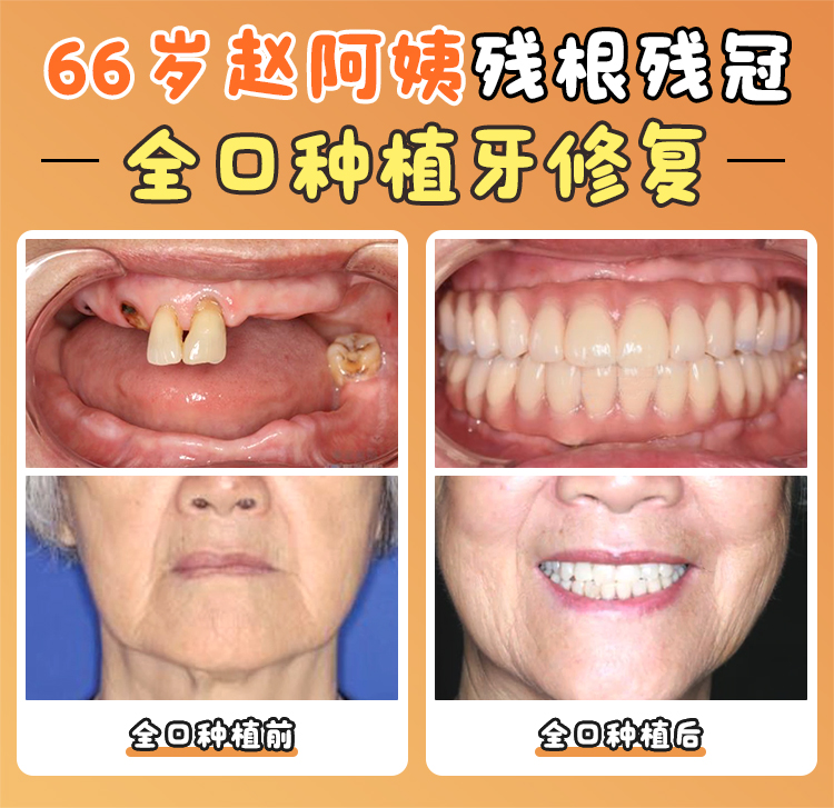 影響卡爾斯種植體壽命的因素