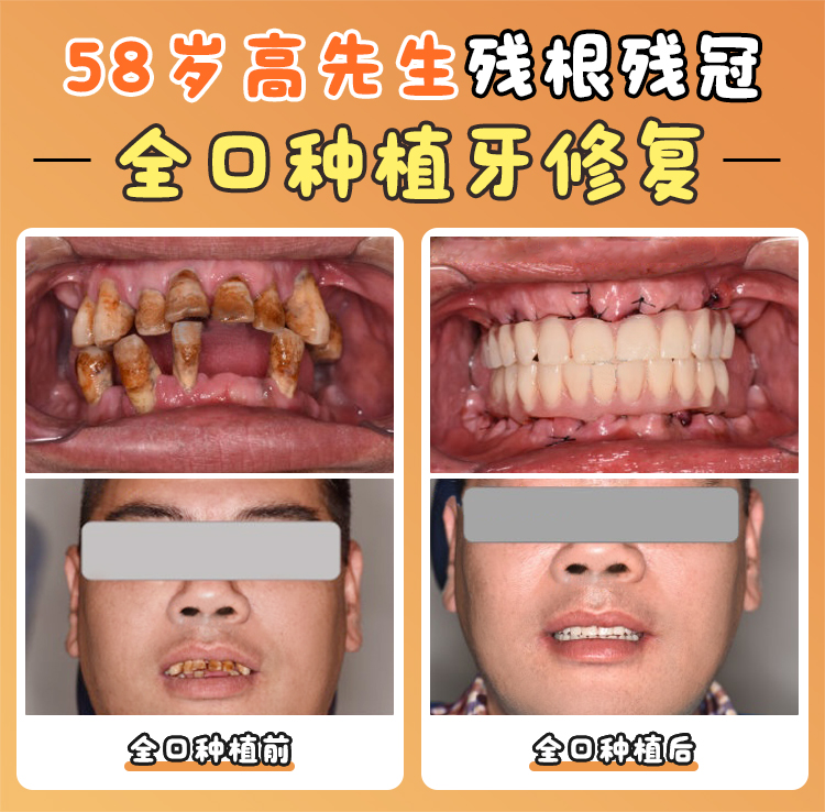 卡爾斯種植體生產(chǎn)基地優(yōu)勢(shì)