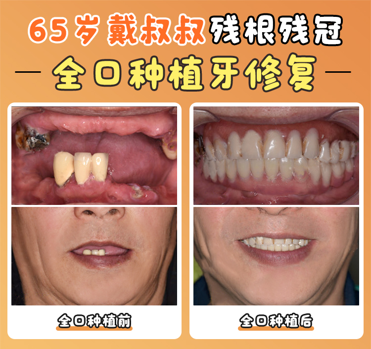 卡爾斯種植體技術(shù)優(yōu)勢(shì)