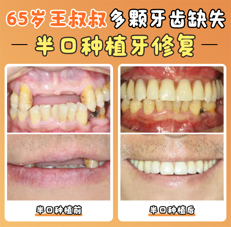 卡爾斯種植體價(jià)格優(yōu)勢(shì)