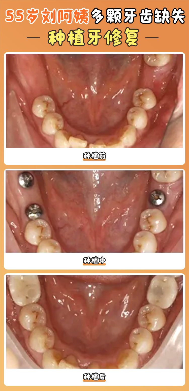 卡爾斯種植體與其他品牌對(duì)比優(yōu)勢(shì)