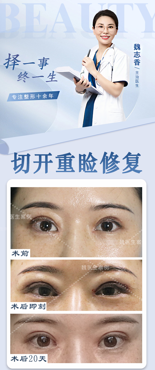 什么是“凹型截骨取肋+薄鼻根假體雕刻”？張海洋醫(yī)生手術特色詳解