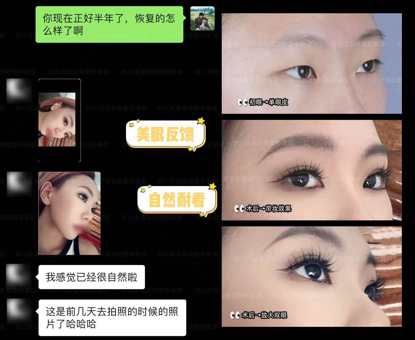 江蘇南通友誼整形做保留粘膜全段緊縮術(shù)有啥優(yōu)勢？