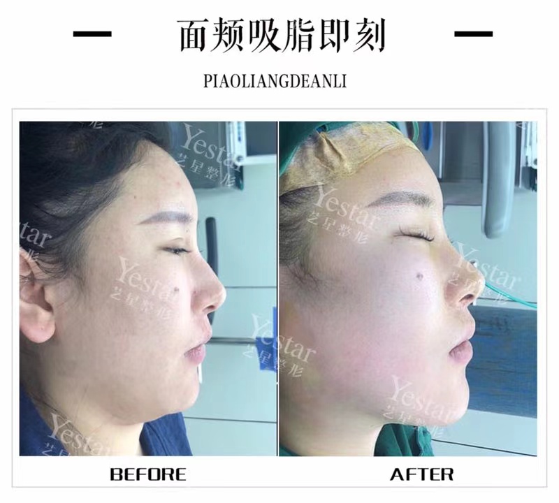 三、深圳福雅整形醫(yī)院熱門項目——假體豐臀