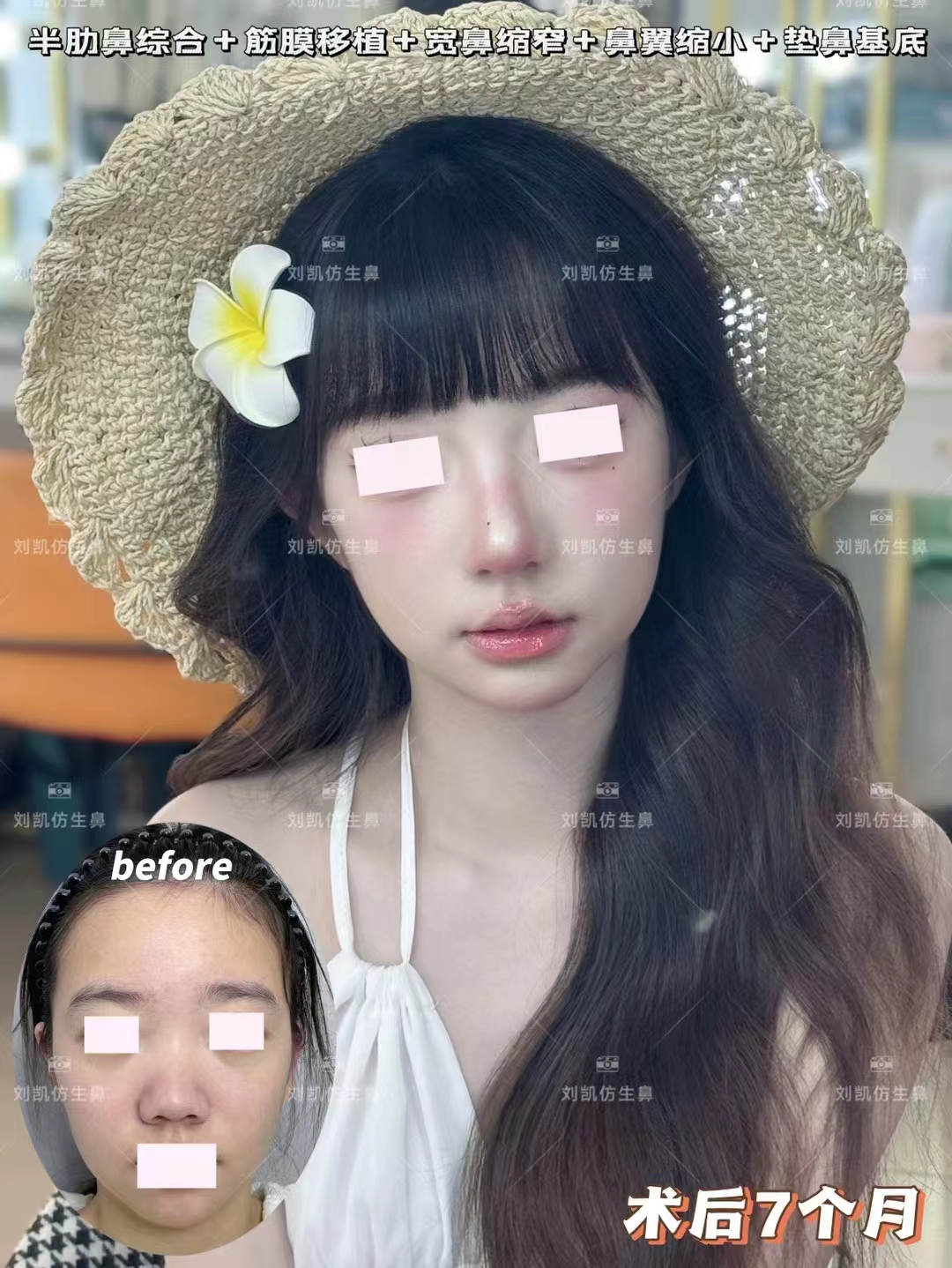 为什么要选择袁强博士做拉皮手术？