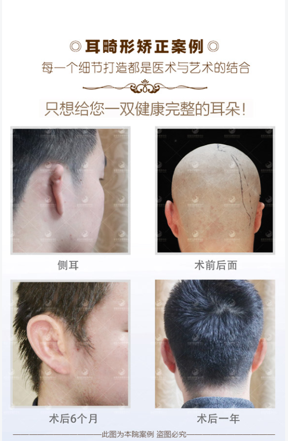 拉皮手术前需要做哪些准备?