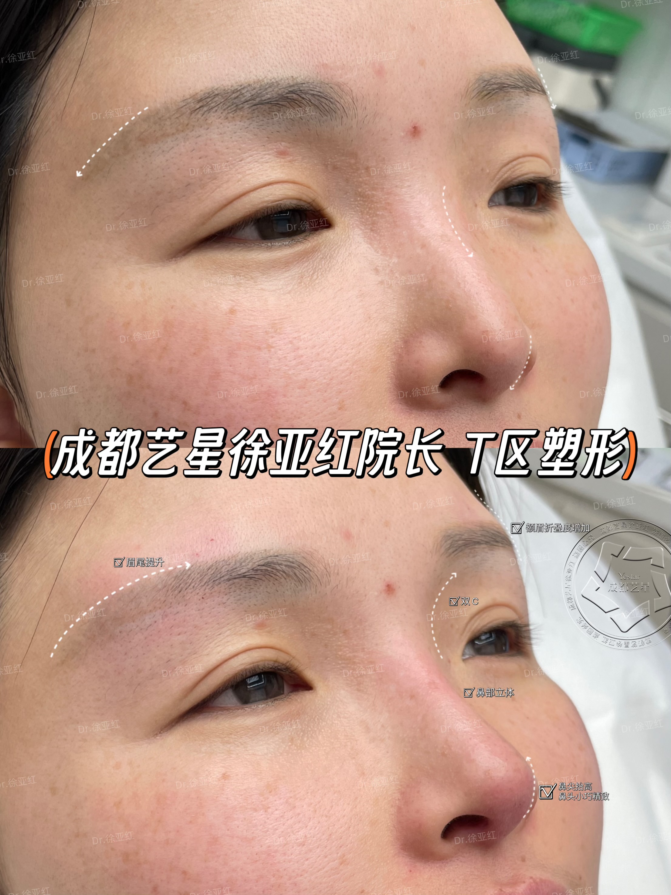 三、北京袁強博士拉皮手術的成效呈現(xiàn)