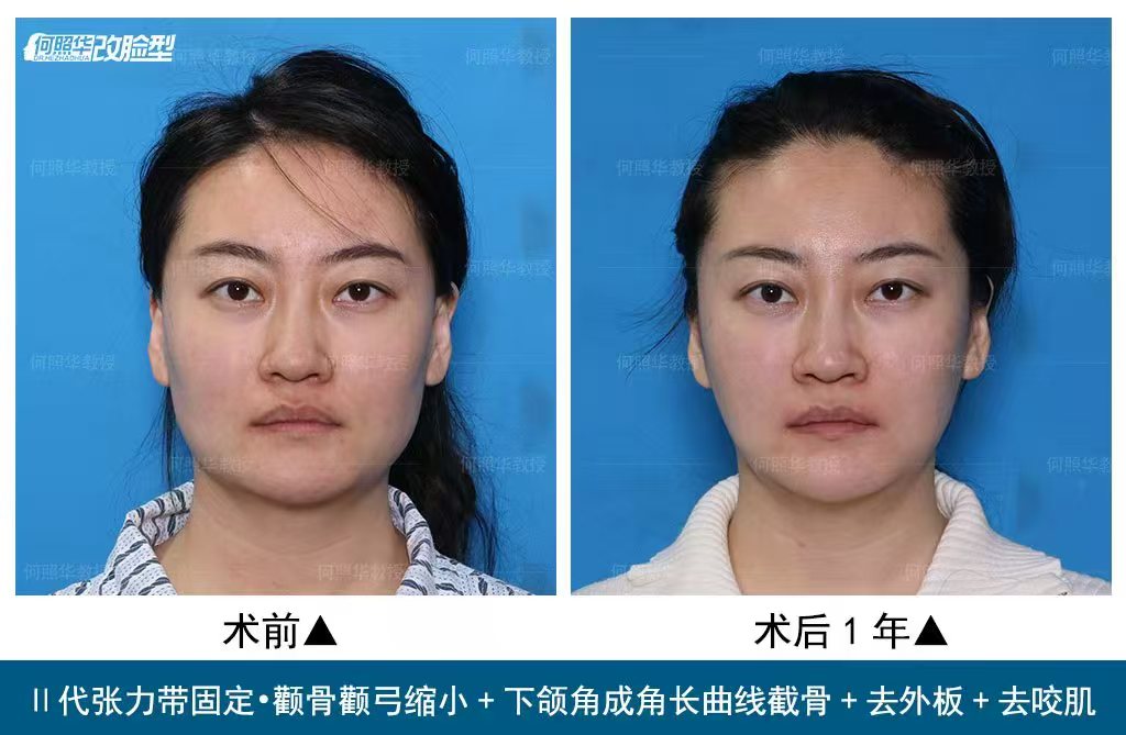 北京联合丽格等三院袁强博士大拉皮手术，价格低至58000元起！ 