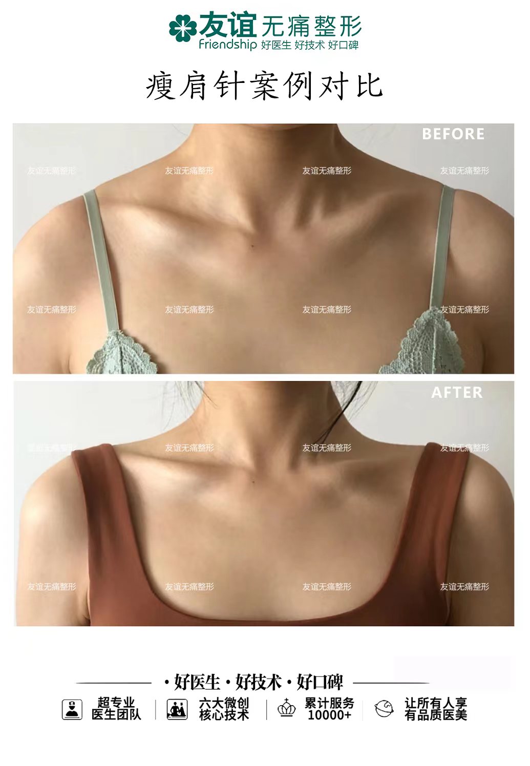 南通康美美容醫(yī)院做保留粘膜全段緊縮術(shù)靠譜不？