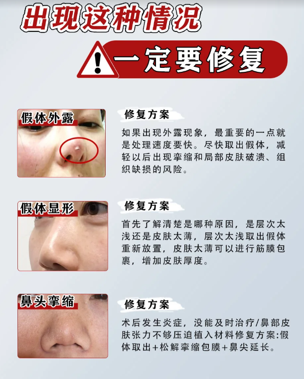 三、黄开亮修复鼻成效如何？真实实例说话，修复后鼻子更自然