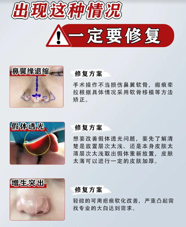 二、黄开亮修复鼻技术怎么样？三大核心优势，解决鼻修复难点