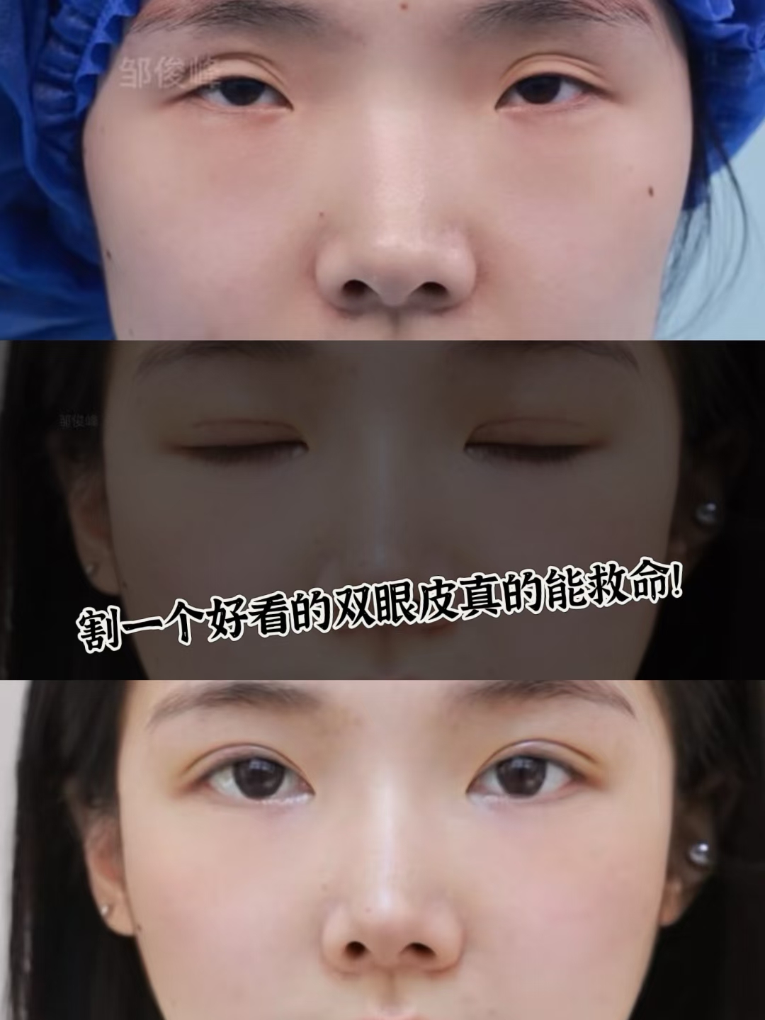 鄭小紅醫(yī)生擅長(zhǎng)修復(fù)哪些類型的雙眼皮失敗問(wèn)題？