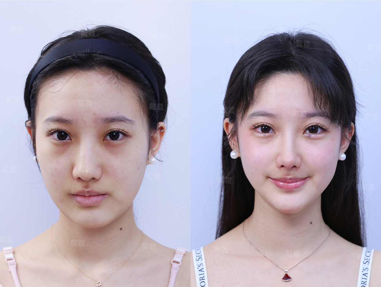 袁强博士大拉皮价格在多少钱？了解专业医美水平下大拉皮的合理收费标准 