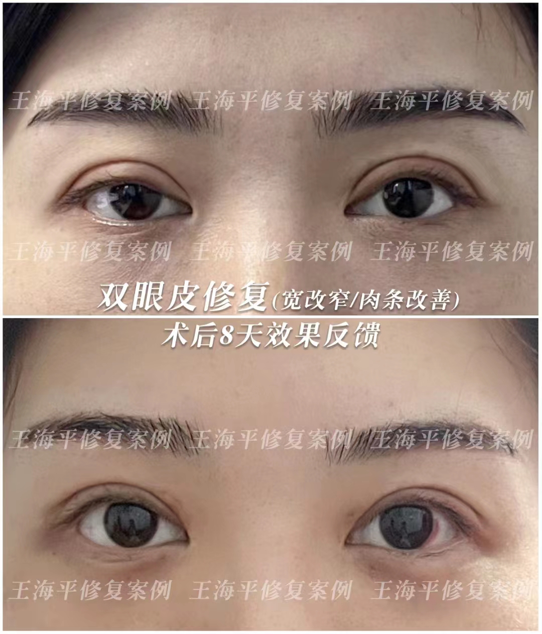 鄭小紅醫(yī)生態(tài)度耐心，術(shù)后服務(wù)規(guī)范，評(píng)價(jià)出圈