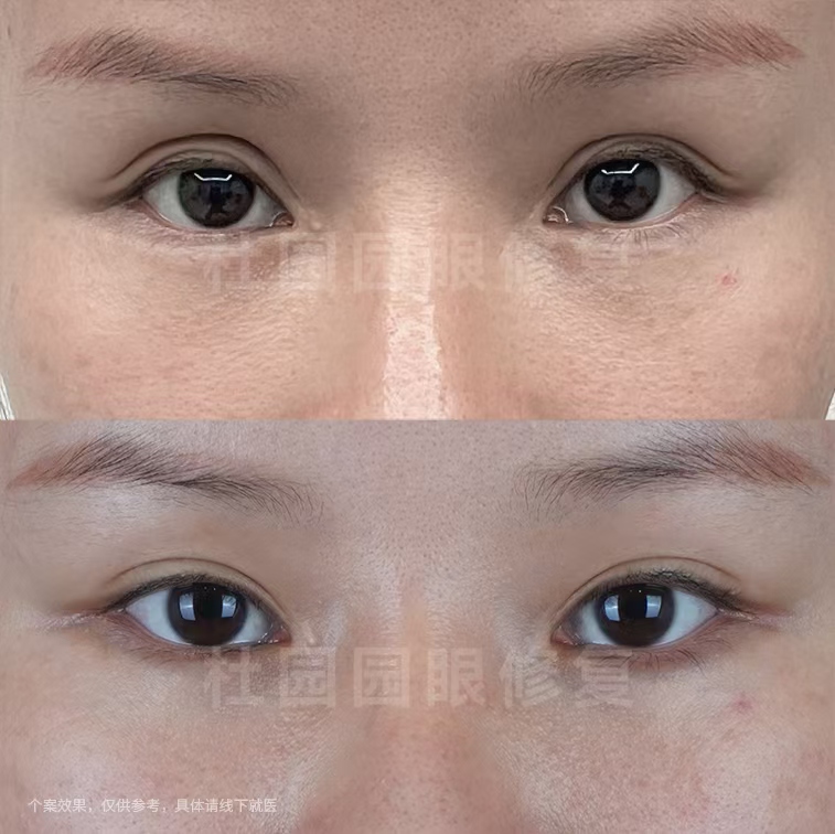 成功修復(fù)實(shí)例反饋為何將她推至上海眼修復(fù)T0梯隊(duì)？