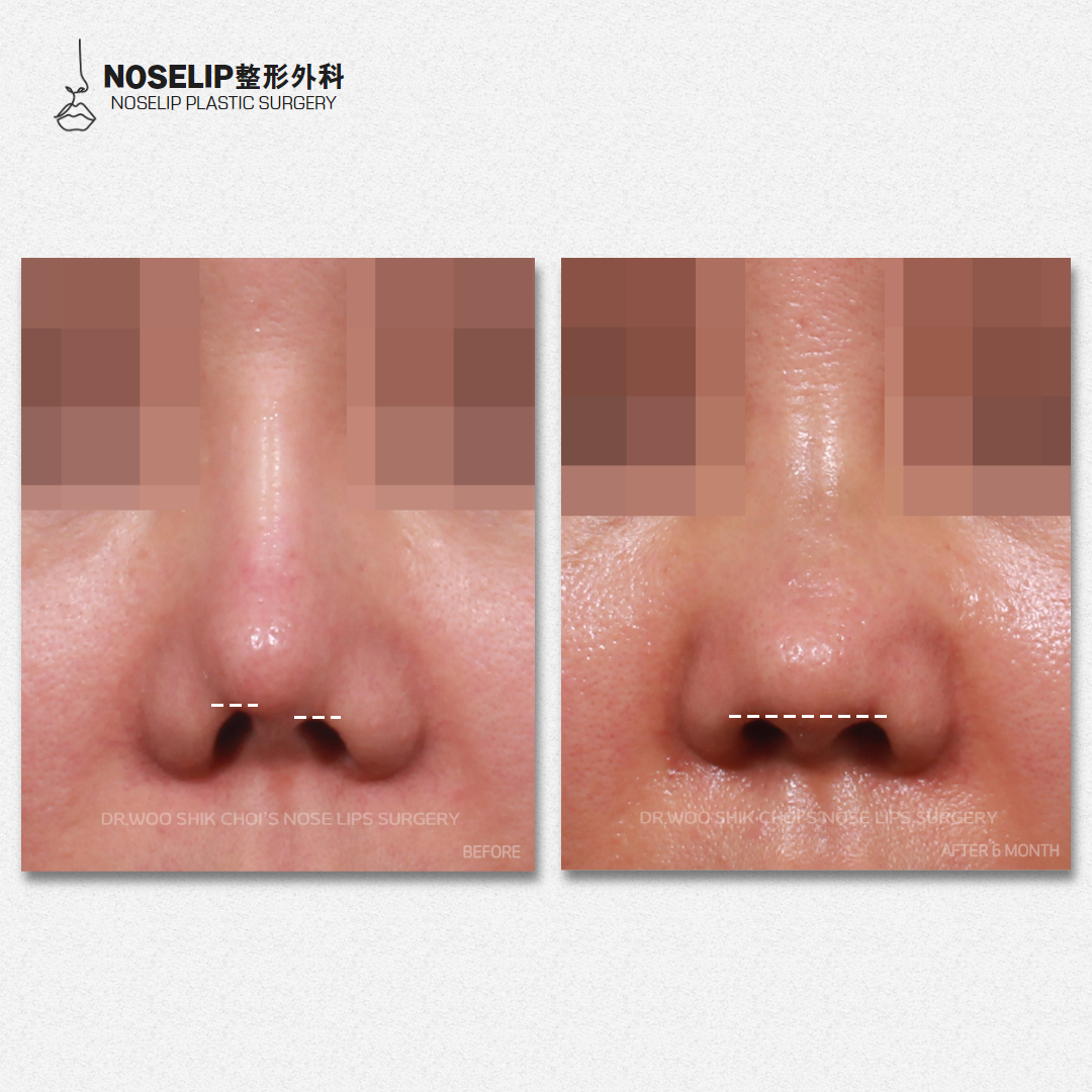 七、黄开亮修复鼻注意事项？术前术后都要重视，确保成效