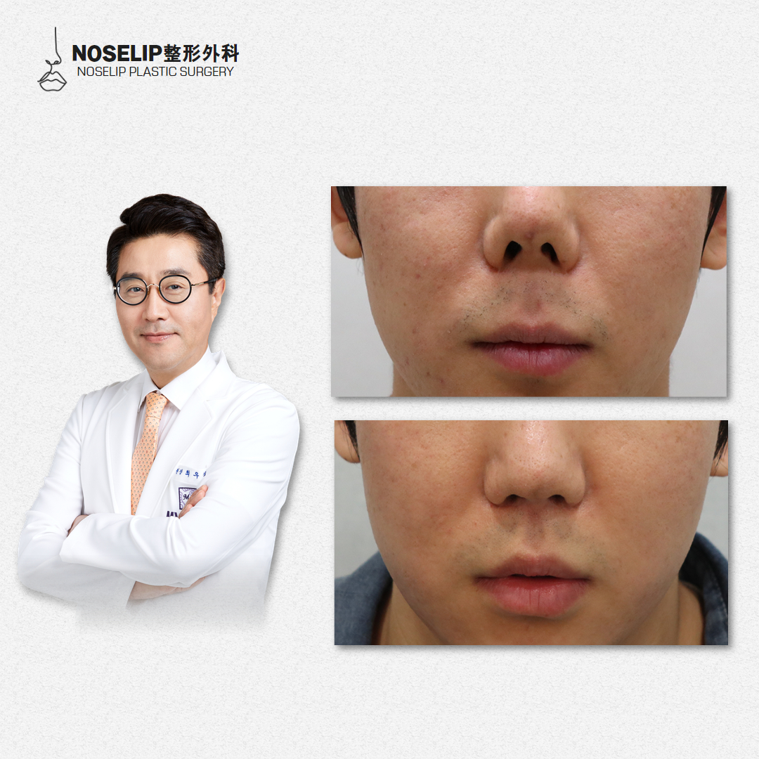 结尾：成都黄开亮修复鼻怎么样？他是“鼻修复”的“定心丸”