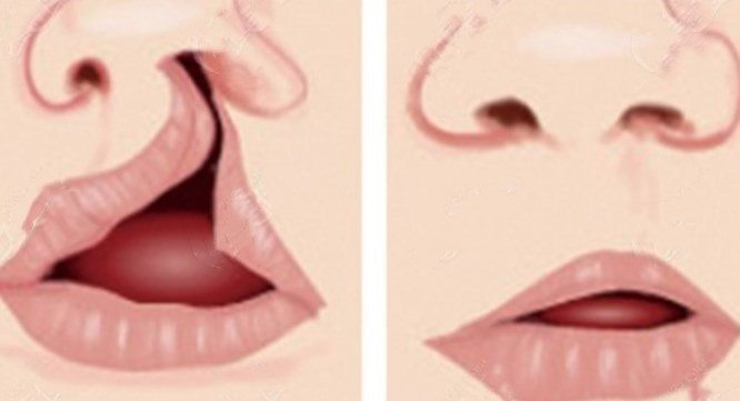 北京唇裂二次修復(fù)