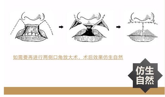 北京唇裂二次修復(fù)的關(guān)鍵考量因素
