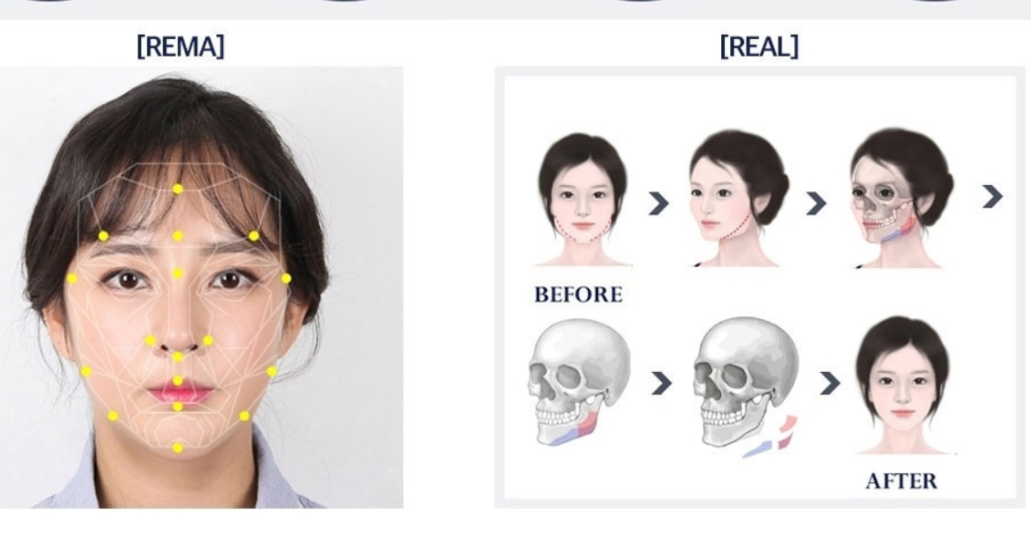 韩国菲斯莱茵整形外科轮廓四件套