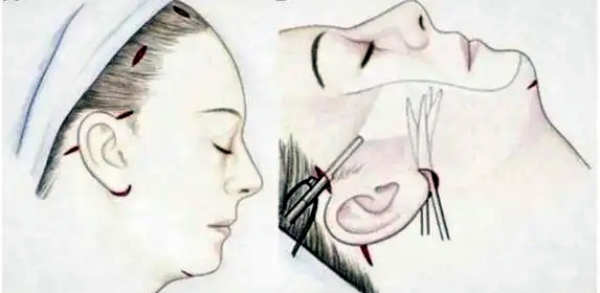 北京黄寺小拉皮价格