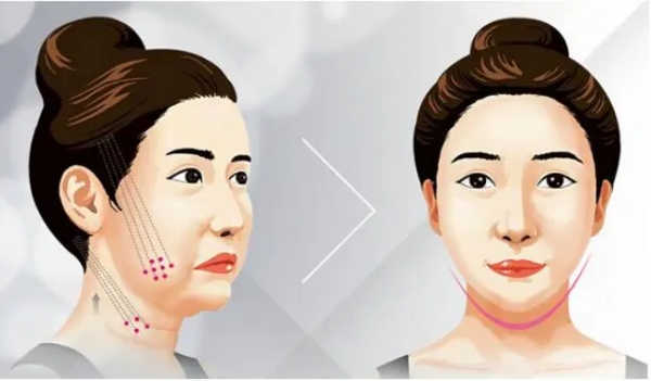 隋冰医生拉皮手术技术及优势