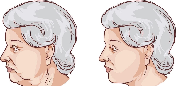 刘暾医生拉皮手术技术