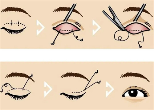 上海于晓雪双眼皮修复怎么样，从技术细节和长期案例看真相