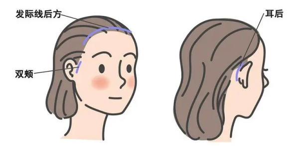 刘暾医生拉皮手术选择建议