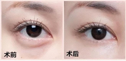 2026上海去黑眼圈好的医院排行榜出炉!艺星、华美、美莱医疗去黑眼圈口碑好登前三