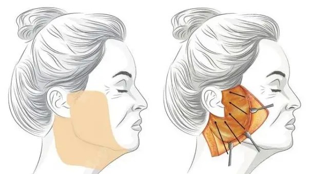 赵寅局拉皮手术多少钱