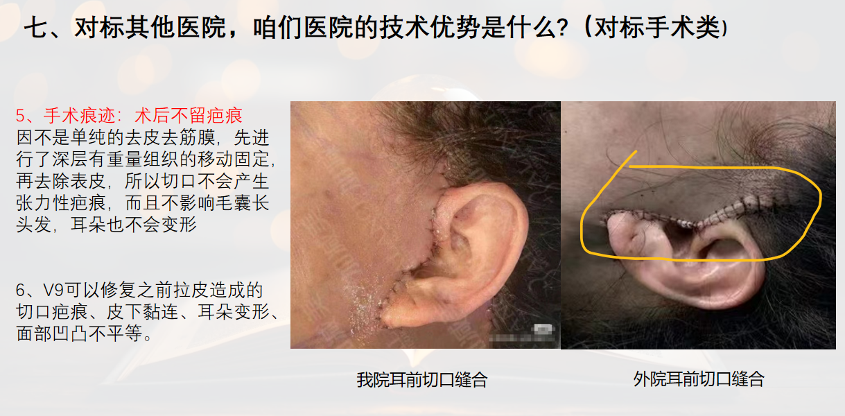 总结：谁才是修复双眼皮的至佳选择？