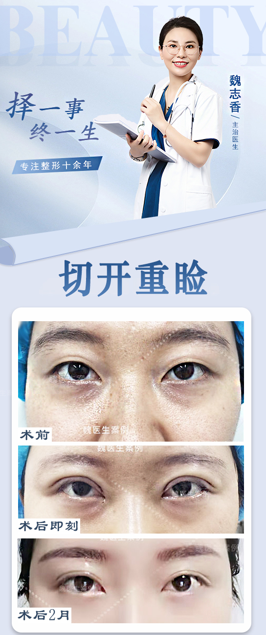 宜兴华星医疗美容机构正规，双眼皮修复技术咋样？