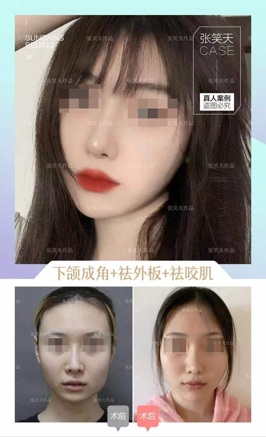 北京假体隆胸价格表：圣嘉新、八大处等多院不同品牌假体及手术附加费用汇总