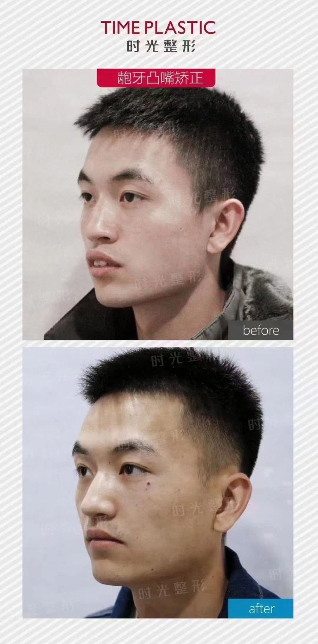 上海徐永丰是做流水线的么？私人定制妈生鼻细节控拒绝模板化整容