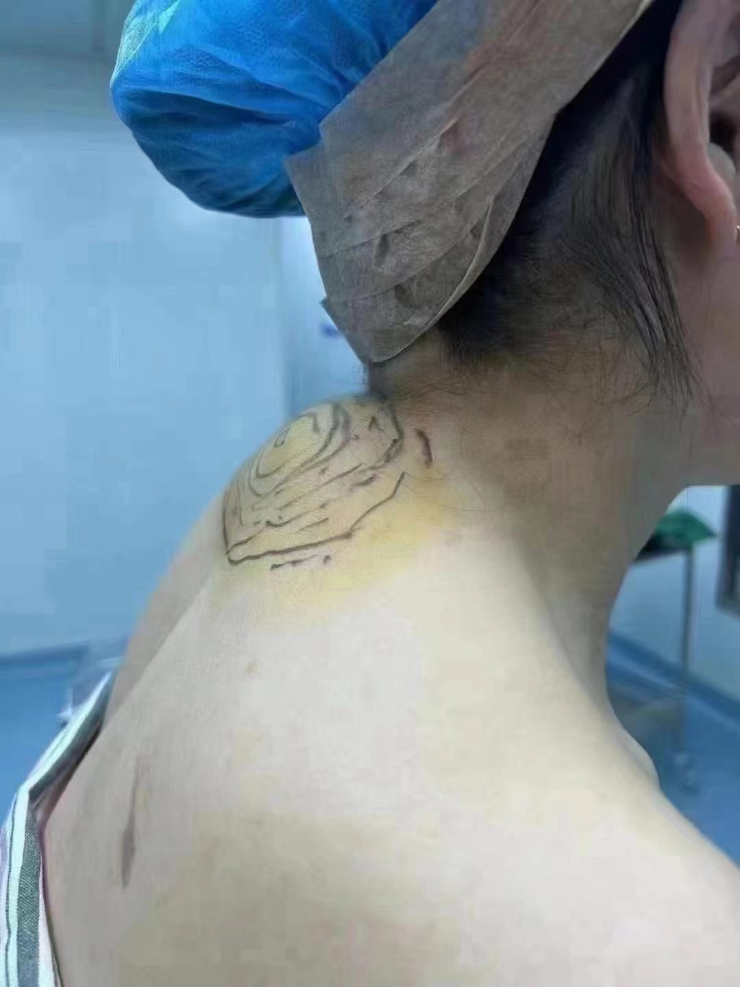 蔡躍波吸脂價格公開：大腿吸脂25,000起/富貴包消除12,000起/全臉面吸8800起/下頜角吸脂8800起