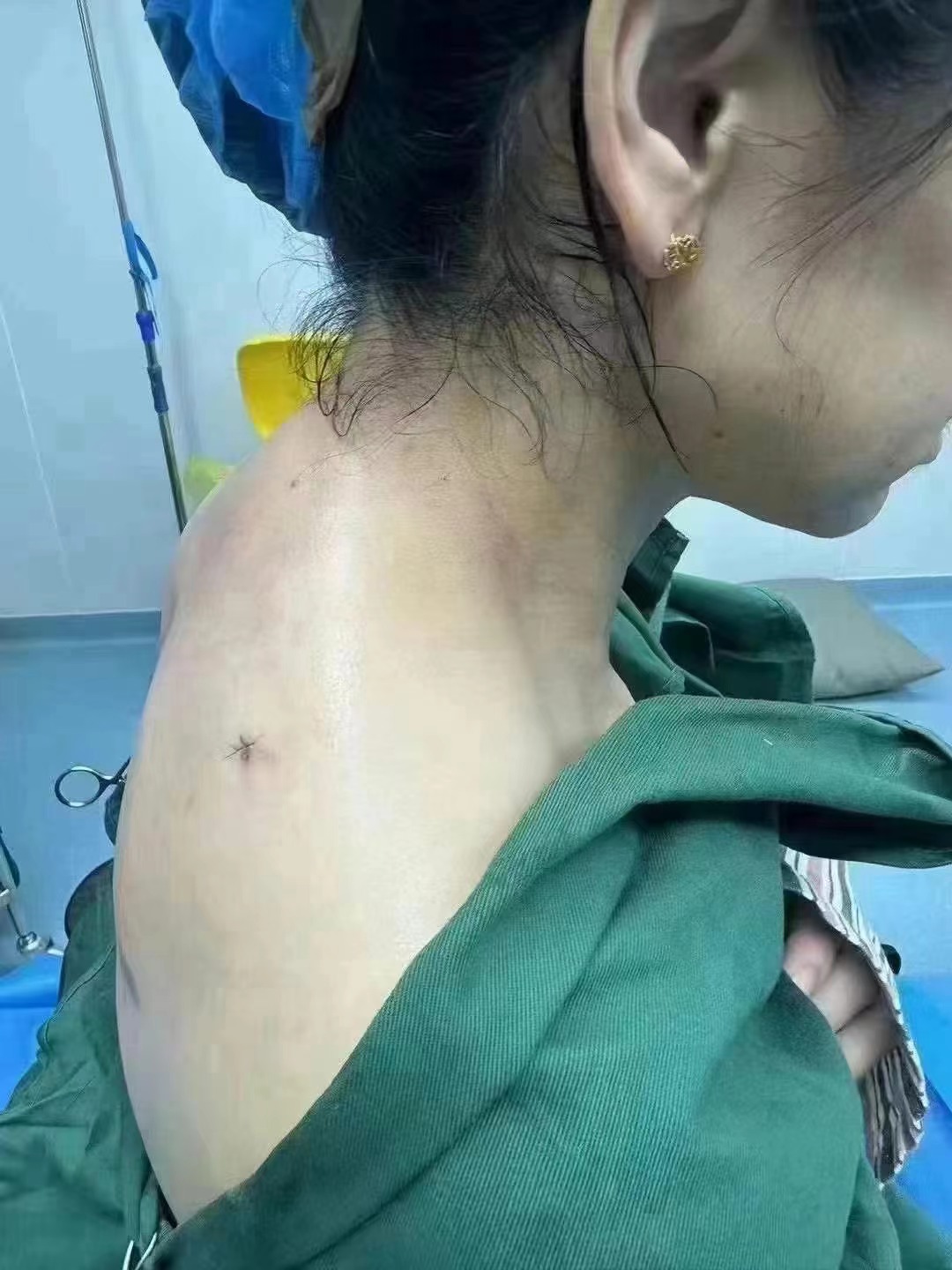 蔡躍波吸脂價(jià)格背后：技術(shù)是“價(jià)格值不值”的核心支撐