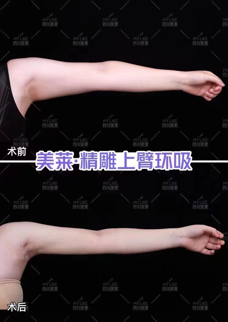 蔡躍波下頜角吸脂價(jià)格：低門檻實(shí)現(xiàn)“小V臉”的關(guān)鍵選擇