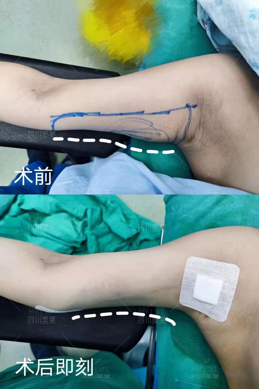 蔡躍波吸脂價(jià)格總結(jié)：透明、合理、有價(jià)值的醫(yī)美選擇