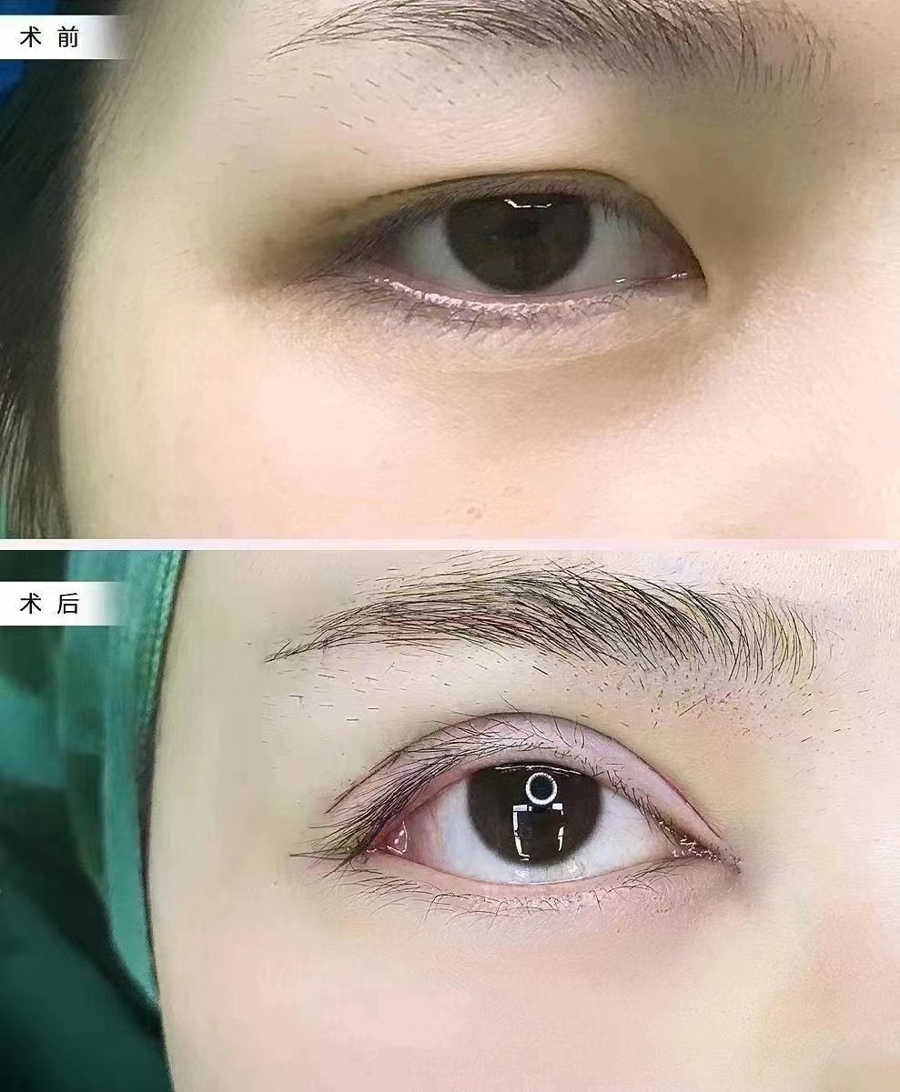 石家庄做双眼皮修复哪家医院好？2026最新医院排行榜+价格参考！